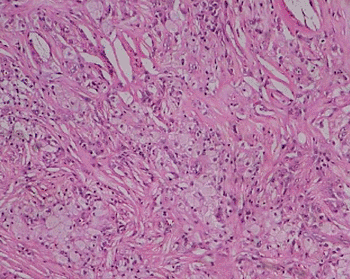 Image: Histological picture of xanthoma showing lipid-laden foam cells with large areas of cholesterol clefts, from a case of familial hypercholesterolemia (Photo courtesy of Anita A Kumar).